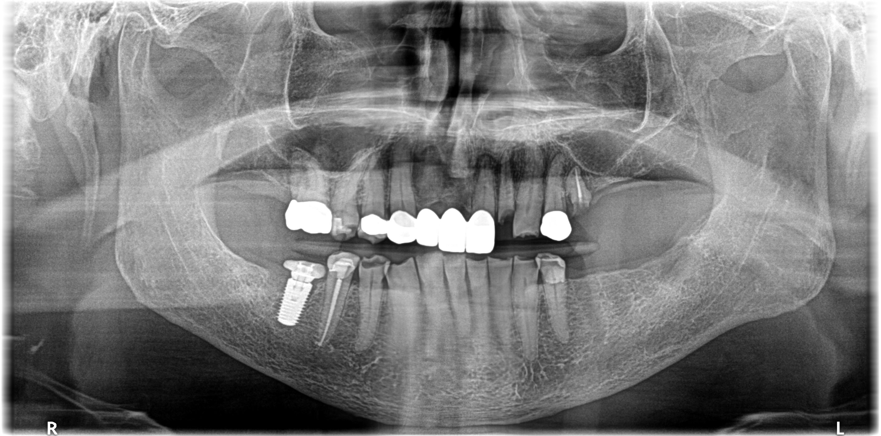Panoramic dental radiograph showing implants, crowns, root canals, restorations, and missing teeth