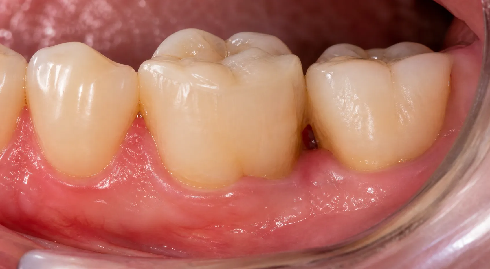 Buccal intraoral view centered on tooth #30