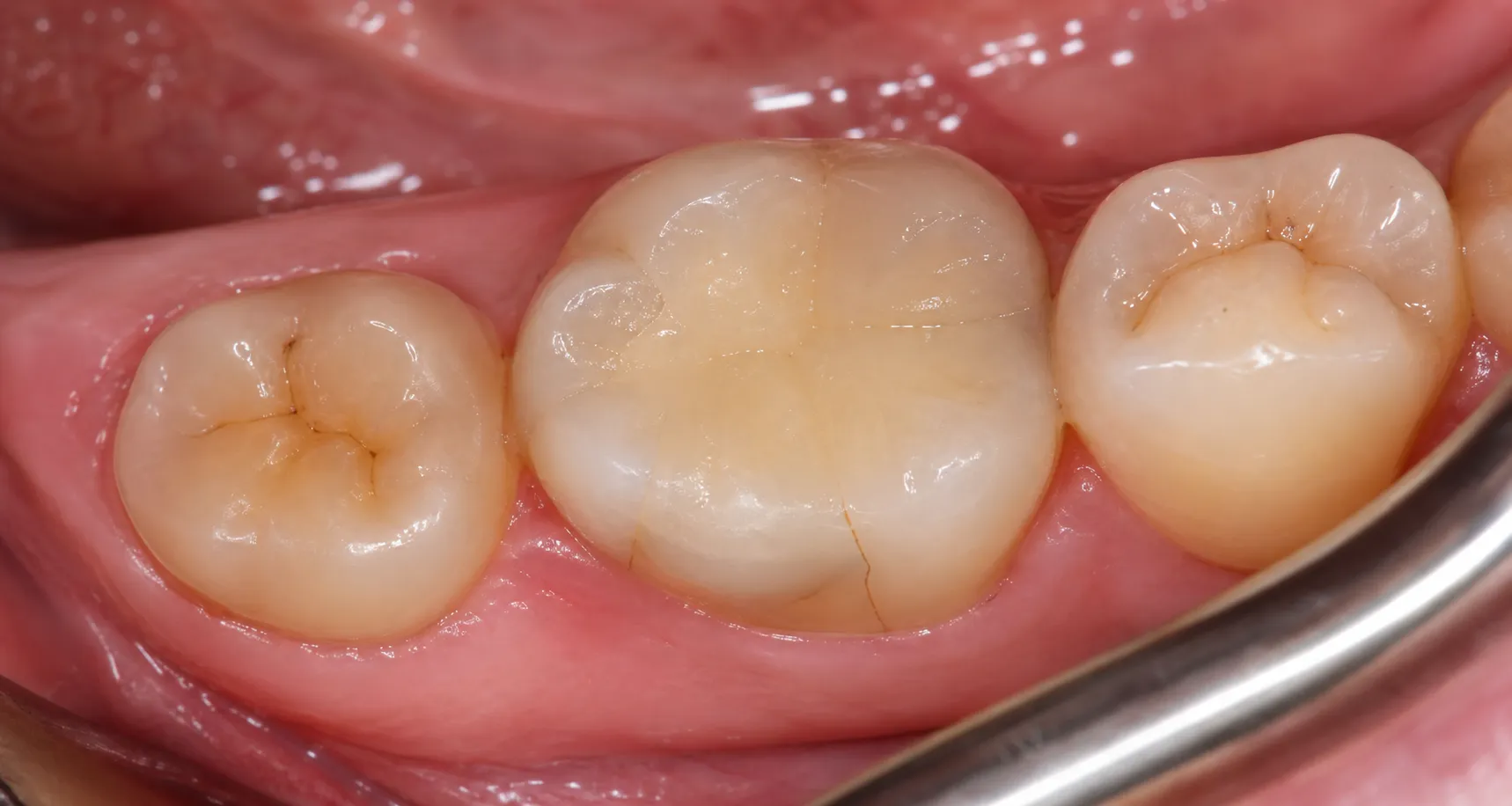 Occlusal intraoral view centered on tooth #30