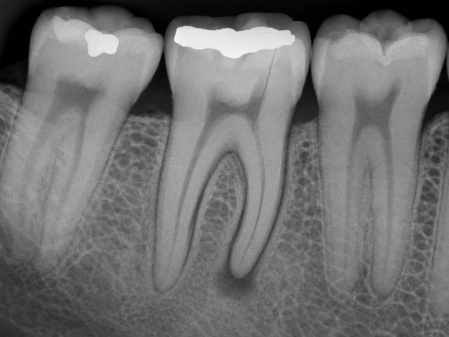 Lower-right posterior dental radiograph centered on tooth #30